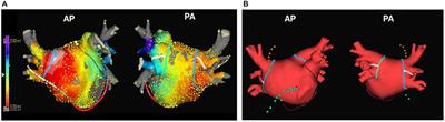 Risk Factors for Stiff Left Atrial Physiology 1 Year After Catheter Ablation of Atrial Fibrillation